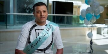 إنجاز طبي جديد بـ«مستشفى أهل مصر».. زراعة جلد تنقذ مريضًا بحروق 84%